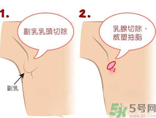 副乳是什么？副乳的危害