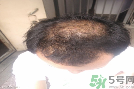 脫發(fā)的措施有什么？脫發(fā)的注意飲食有哪些？