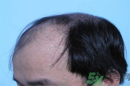 脫發(fā)的措施有什么？脫發(fā)的注意飲食有哪些？