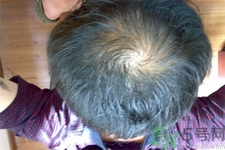 脫發(fā)的高發(fā)人群有哪些？如何預(yù)防脫發(fā)？