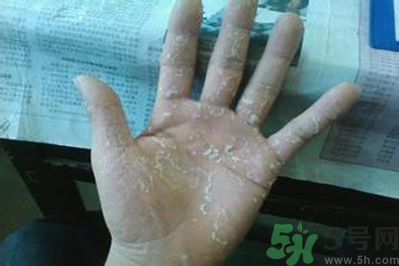 引起手足癬的主要原因？手足癬會引發(fā)什么疾病？