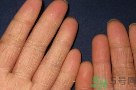 手足癬的治療方法？治療手足癬可以用什么藥？
