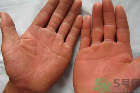 手足癬的治療方法？治療手足癬可以用什么藥？