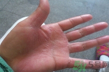 手足癬的易發(fā)人群有哪些？如何預(yù)防手足癬？