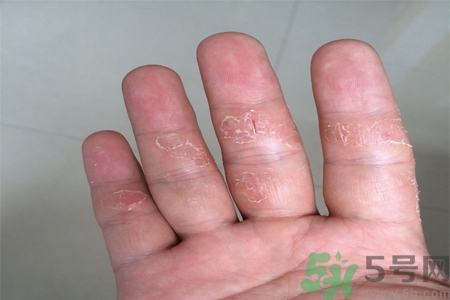 手足癬的易發(fā)人群有哪些？如何預(yù)防手足癬？