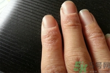 手足癬會(huì)傳染嗎？手足癬的傳播途徑有哪些？