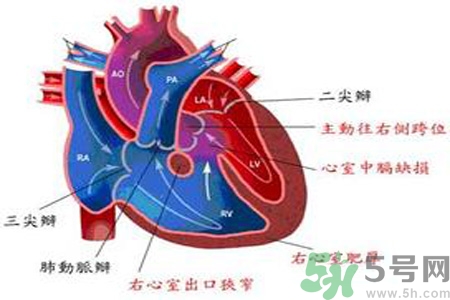 先天性心臟病發(fā)病原因是什么？