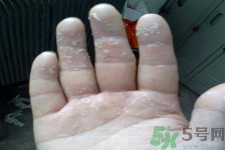 手足癬的易發(fā)人群有哪些？如何預(yù)防手足癬？