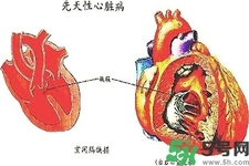 心臟病的癥狀是什么？心臟病的種類有哪些？