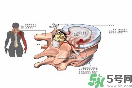 為什么年輕人容易得頸椎?。款i椎病嚴重的癥狀有哪些？