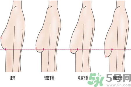 ?女性乳房下垂的原因是什么？女性乳房下垂的分類有哪些？