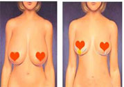 ?女性乳房下垂的原因是什么？女性乳房下垂的分類有哪些？