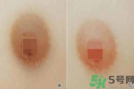 乳頭發(fā)黑怎么辦？怎么樣可以使乳頭變白？