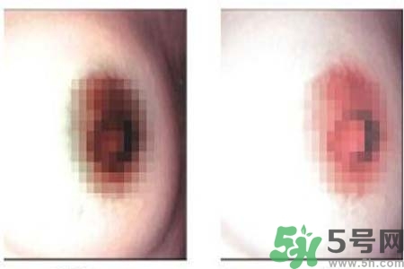 乳頭發(fā)黑怎么辦？怎么樣可以使乳頭變白？