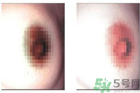 乳頭發(fā)黑是怎么回事？乳頭發(fā)黑是什么原因？