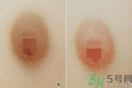 乳頭發(fā)黑是怎么回事？乳頭發(fā)黑是什么原因？