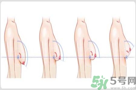 胸部松弛的原因是什么？胸部松弛該怎么辦？