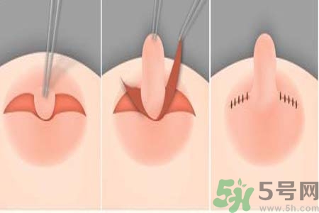 乳頭內(nèi)陷怎么回事？乳頭內(nèi)陷的原因是什么？