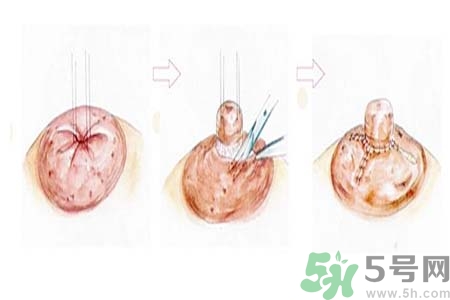 乳頭內(nèi)陷怎么回事？乳頭內(nèi)陷的原因是什么？