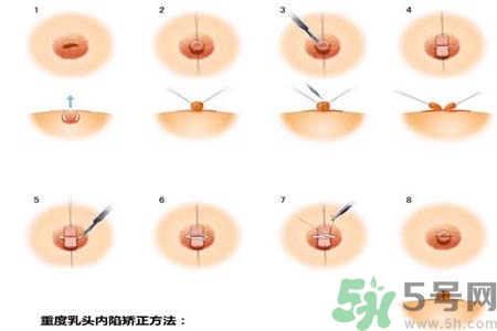 乳頭內(nèi)陷怎么回事？乳頭內(nèi)陷的原因是什么？