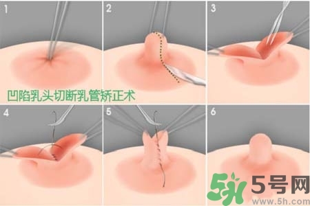 乳頭內(nèi)陷怎么辦？乳頭內(nèi)陷的癥狀有哪些？