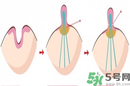乳頭內(nèi)陷怎么辦？乳頭內(nèi)陷的癥狀有哪些？
