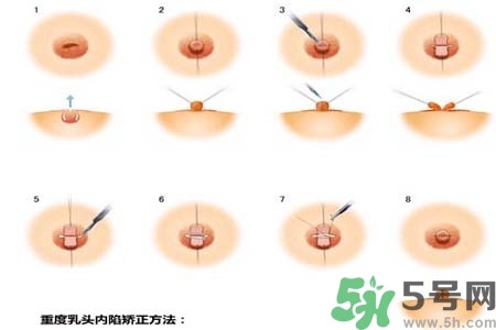乳頭內(nèi)陷怎么辦？乳頭內(nèi)陷的癥狀有哪些？