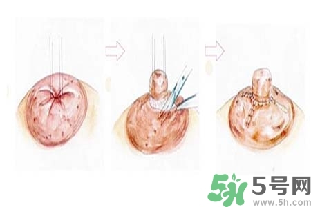 乳頭內(nèi)陷怎么辦？乳頭內(nèi)陷的癥狀有哪些？