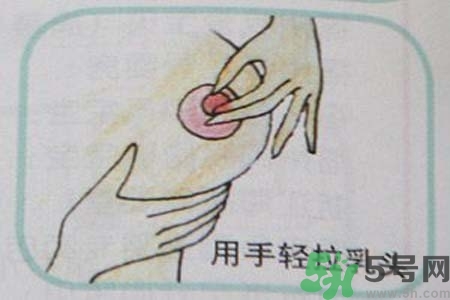 乳頭內(nèi)陷怎么辦？乳頭內(nèi)陷的癥狀有哪些？