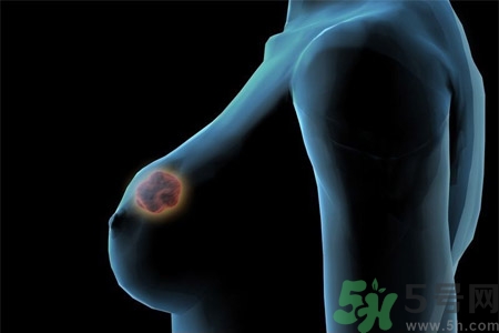 乳房屋硬塊有疼痛感怎么回事？乳房屋硬塊有疼痛感怎么辦？