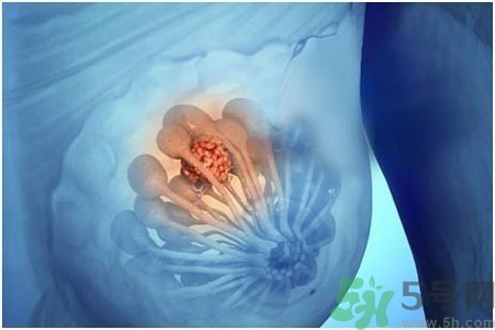 乳房屋硬塊有疼痛感怎么回事？乳房屋硬塊有疼痛感怎么辦？