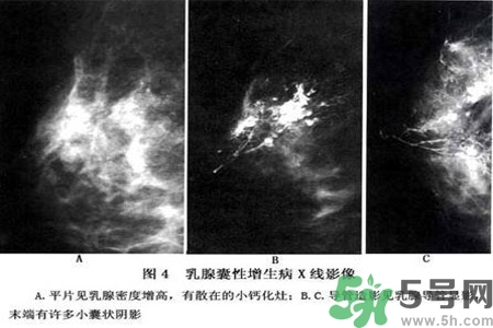 產(chǎn)生乳腺增生鈣化的病因是什么？乳腺增生怎樣治療？