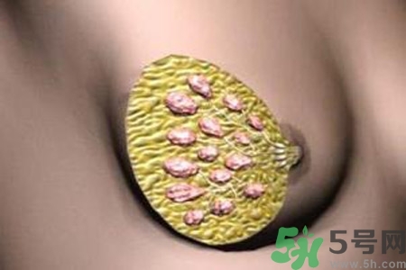 乳腺增生鈣化是什么？乳腺鈣化的癥狀有哪些？