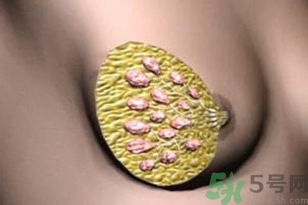 產(chǎn)生乳腺增生鈣化的病因是什么？乳腺增生怎樣治療？