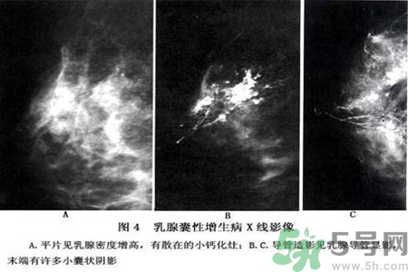 乳腺增生鈣化是什么？乳腺鈣化的癥狀有哪些？