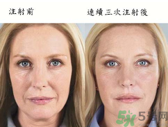 3D液態(tài)拉皮多少錢？3D液態(tài)拉皮后多久見效？