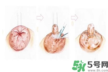 乳頭內(nèi)陷怎么矯正？乳頭內(nèi)陷矯正方法是什么？