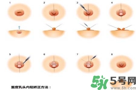 乳頭內(nèi)陷怎么矯正？乳頭內(nèi)陷矯正方法是什么？