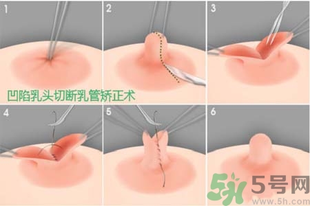 乳頭內(nèi)陷怎么矯正？乳頭內(nèi)陷矯正方法是什么？