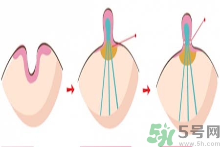 乳頭內(nèi)陷矯正需注意什么？乳頭內(nèi)陷如何預(yù)防？