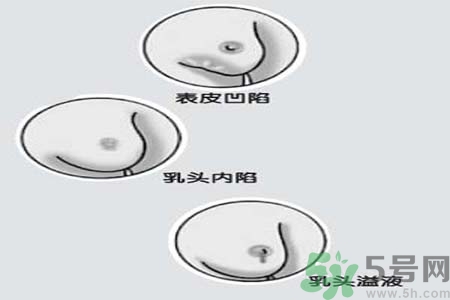 乳頭內(nèi)陷矯正需注意什么？乳頭內(nèi)陷如何預(yù)防？