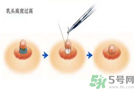 乳頭內(nèi)陷能不能喂奶？乳頭凹陷怎樣哺乳？