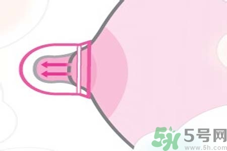 乳頭內(nèi)陷可以拔罐嗎？乳頭內(nèi)陷需要手術(shù)治療嗎？