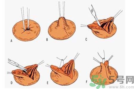 乳頭內(nèi)陷可以拔罐嗎？乳頭內(nèi)陷需要手術(shù)治療嗎？
