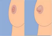 乳頭內(nèi)陷可以用吸奶器嗎？乳頭內(nèi)陷能不能用吸奶器？