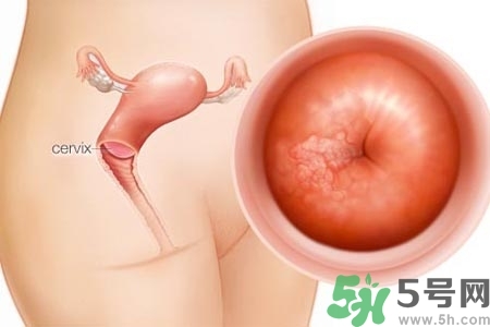 陰道出血和什么有關(guān)？陰道出血的應(yīng)急措施有哪些？