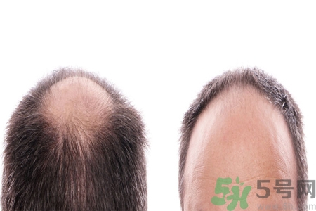 頭發(fā)稀少的原因是什么？如何預(yù)防禿頂?shù)陌l(fā)生？