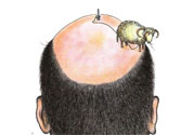 禿頂會遺傳嗎？治療禿頂?shù)姆椒ㄊ鞘裁矗?><p><strong>禿頂會遺傳嗎？治療禿頂?shù)姆椒ㄊ鞘裁矗?/strong></p></a></li> </ul>
</div>
<div   id=