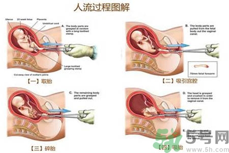 人工流產(chǎn)后多久可以再次懷孕？流產(chǎn)后需要注意什么？