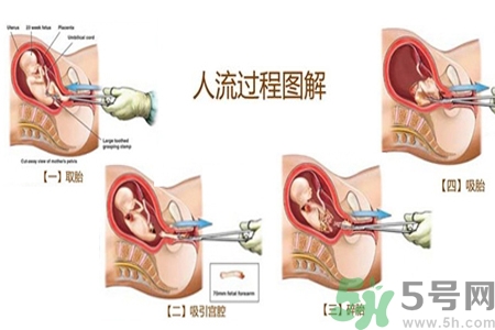 人工流產(chǎn)后多久可以再次懷孕？流產(chǎn)后需要注意什么？